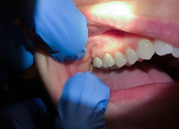 Best Emergency Denture Repair in Garfield, NJ